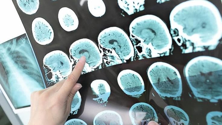 Ictus nella donna, quanto incide la fibrillazione atriale? Ecco cosa fare e quando